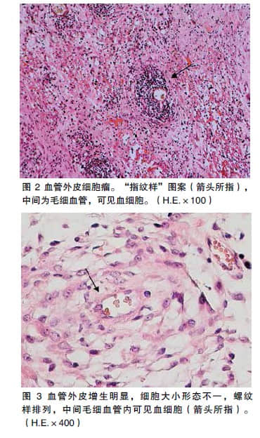 血管外皮细胞瘤病例分析 血管外皮细胞瘤病例分析