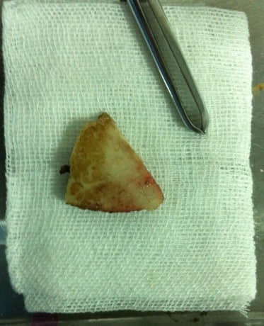 3个月贵宾犬胸腔段食道异物的手术治疗 3个月贵宾犬胸腔段食道异物的手术治疗
