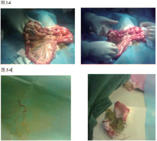 一例肠道线性堵塞的病例报告 一例肠道线性堵塞的病例报告