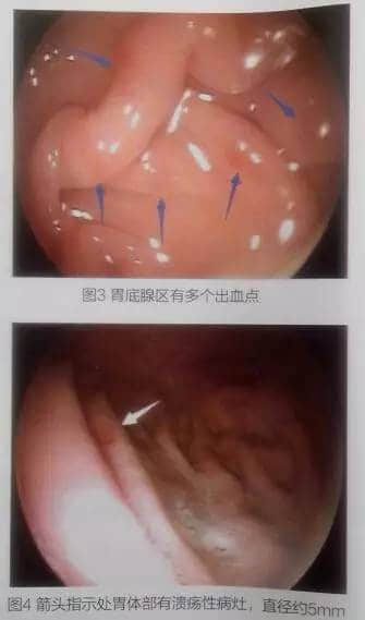 一例犬胃溃疡的内窥镜与组织病理学检查 一例犬胃溃疡的内窥镜与组织病理学检查