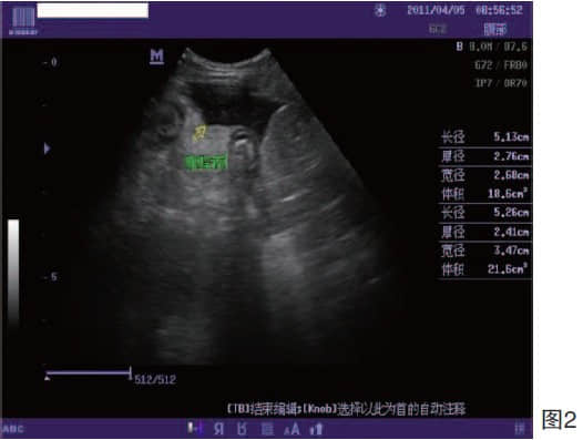 一例肠道线性堵塞的病例报告 一例肠道线性堵塞的病例报告