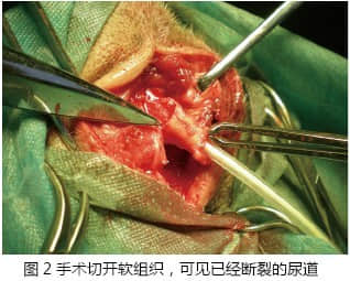 导尿不当导致尿道断裂的诊断与治疗 导尿不当导致尿道断裂的诊断与治疗