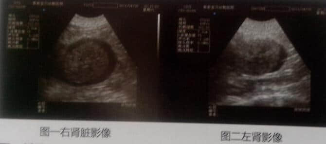 一例15岁家猫双肾周囊肿被膜下积液 一例15岁家猫双肾周囊肿被膜下积液