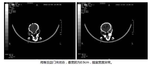 博美犬脑积水的CT诊断 博美犬脑积水的CT诊断