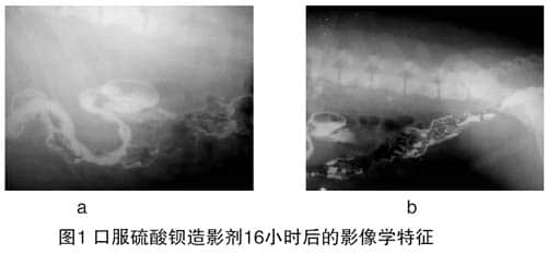 替泊沙林引起肠道溃疡的病例报道 替泊沙林引起肠道溃疡的病例报道